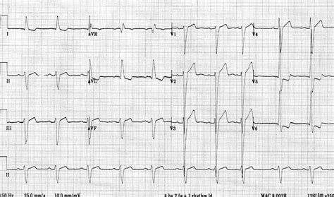 ecg showing lvh.